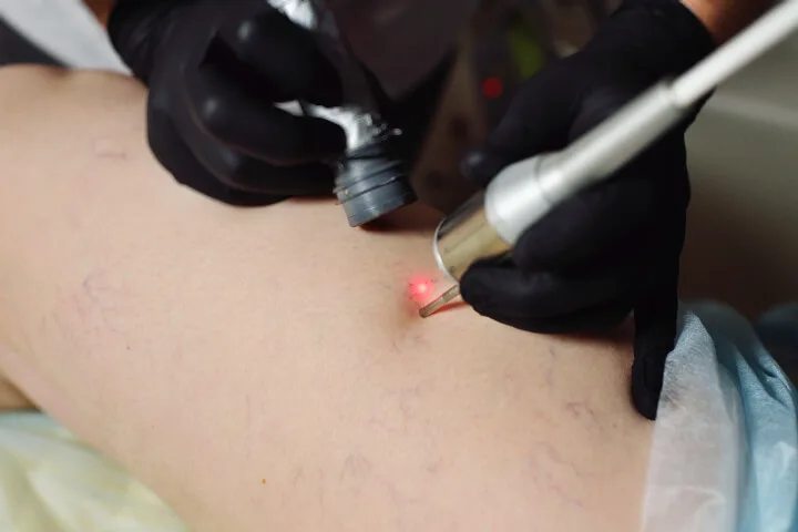 How Long Will My Spider Veins Stay Away If I Laser Them?