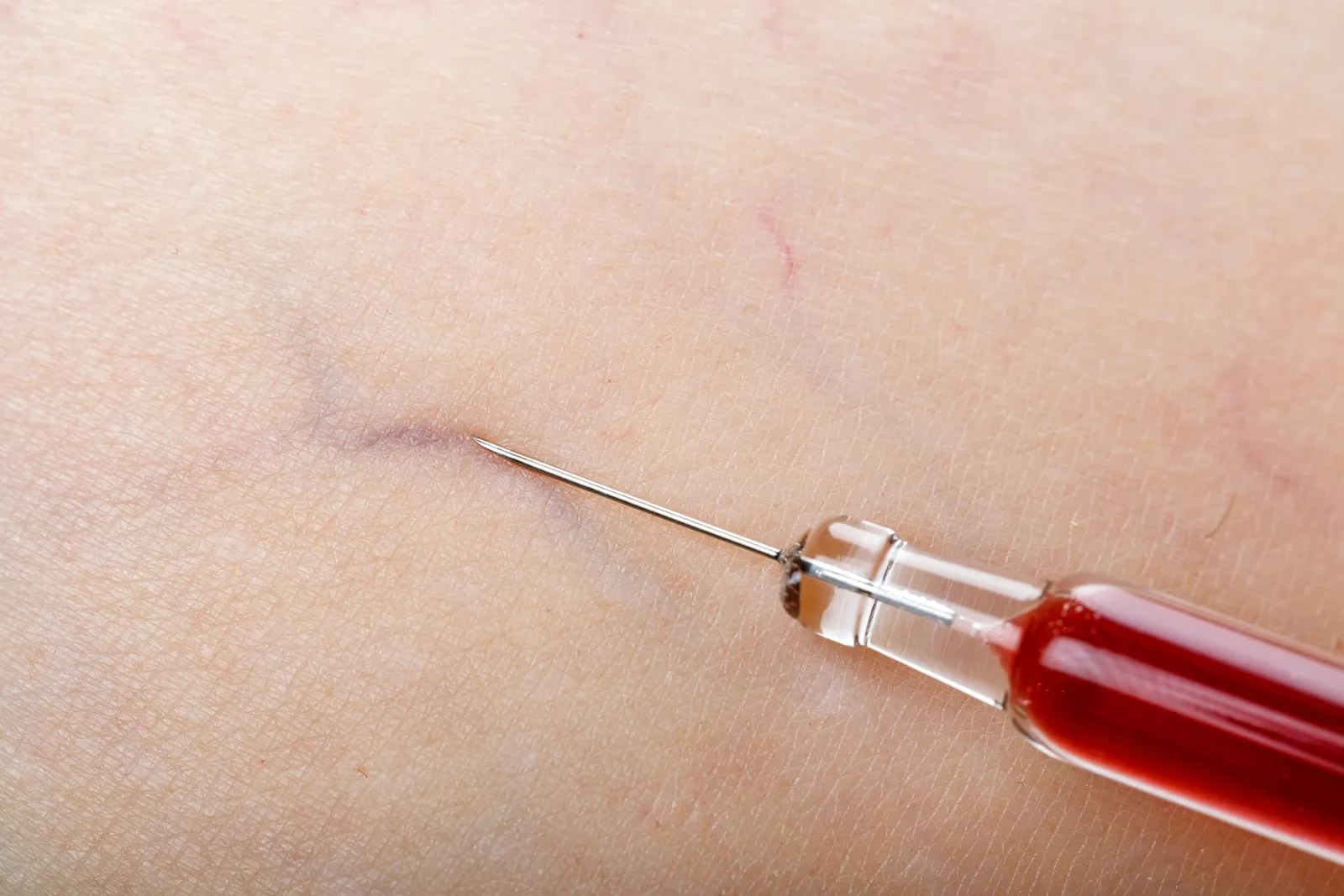 Beat the Creep: Effective Treatments for Small Spider Veins