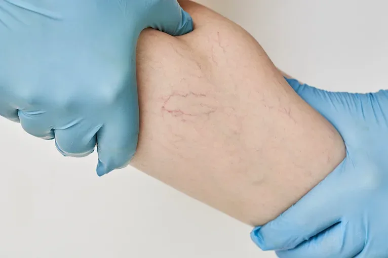Gloved hands holding a leg with chronic venous insufficiency