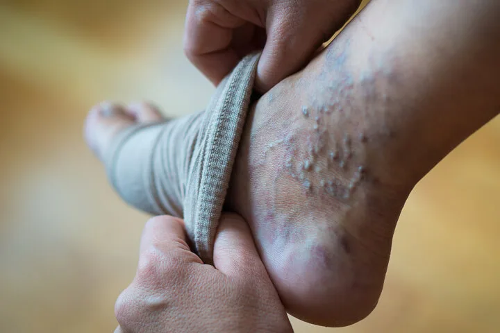 Importance of Compression Tights for Varicose Veins