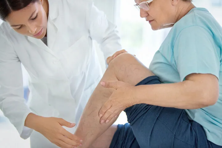 Can You Wax Over Varicose Veins?