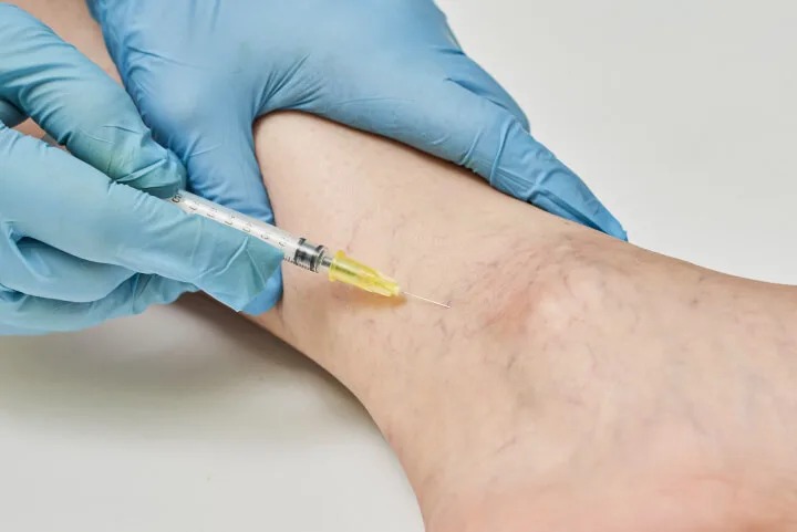 sclerotherapy