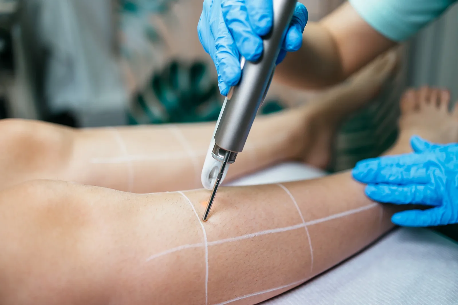 When Was Endovenous Laser Ablation Varicose Vein Procedure